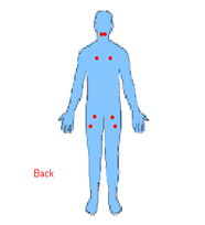 Fibromyalgia posterior tender points