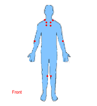 Fibromyalgia anterior tender points